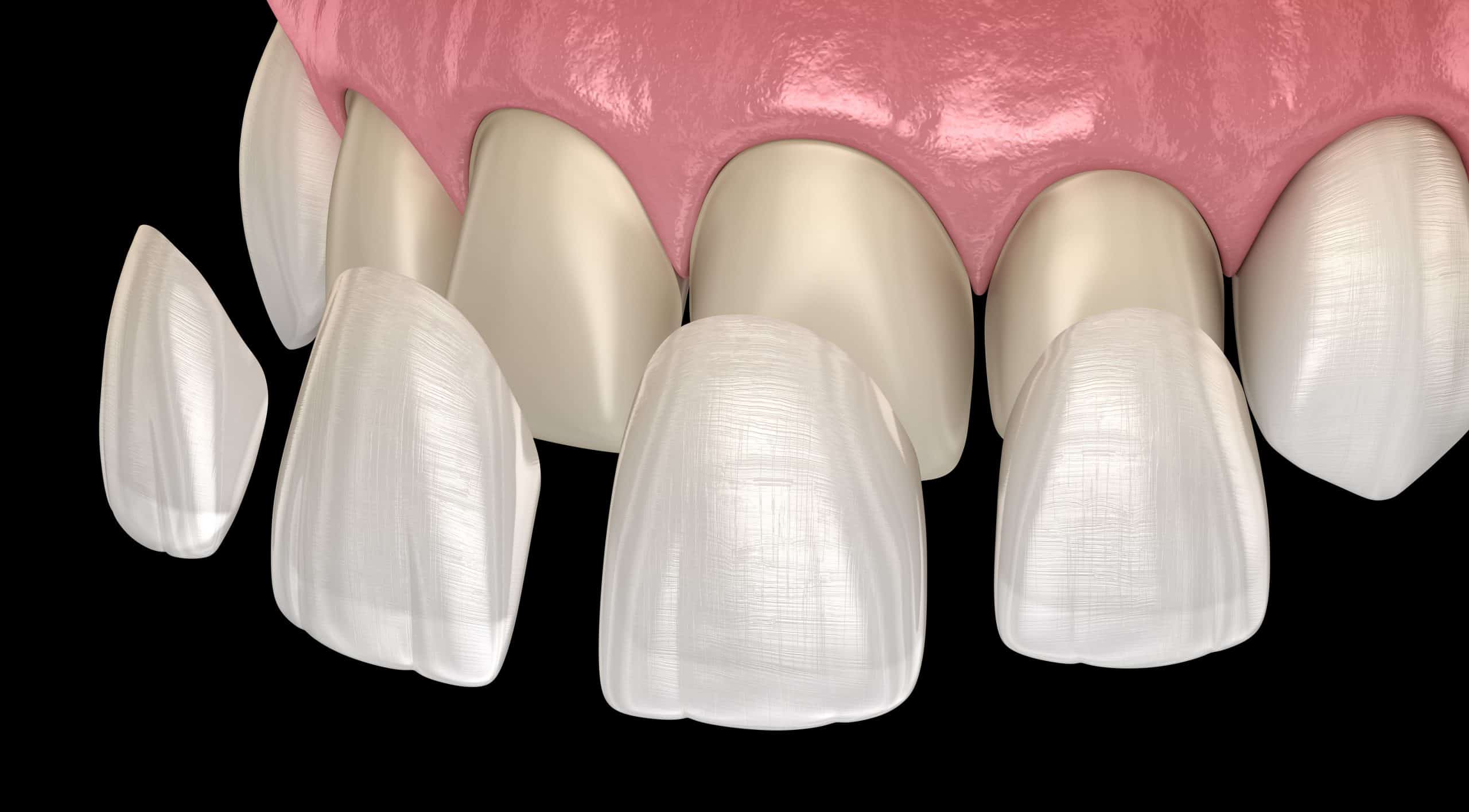 Illustration showing dental veneers placed over front teeth to improve appearance and protect worn or damaged enamel