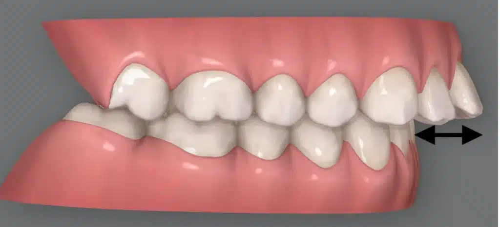 Side view illustration of teeth showing an overjet, where the upper front teeth extend forward beyond the lower teeth