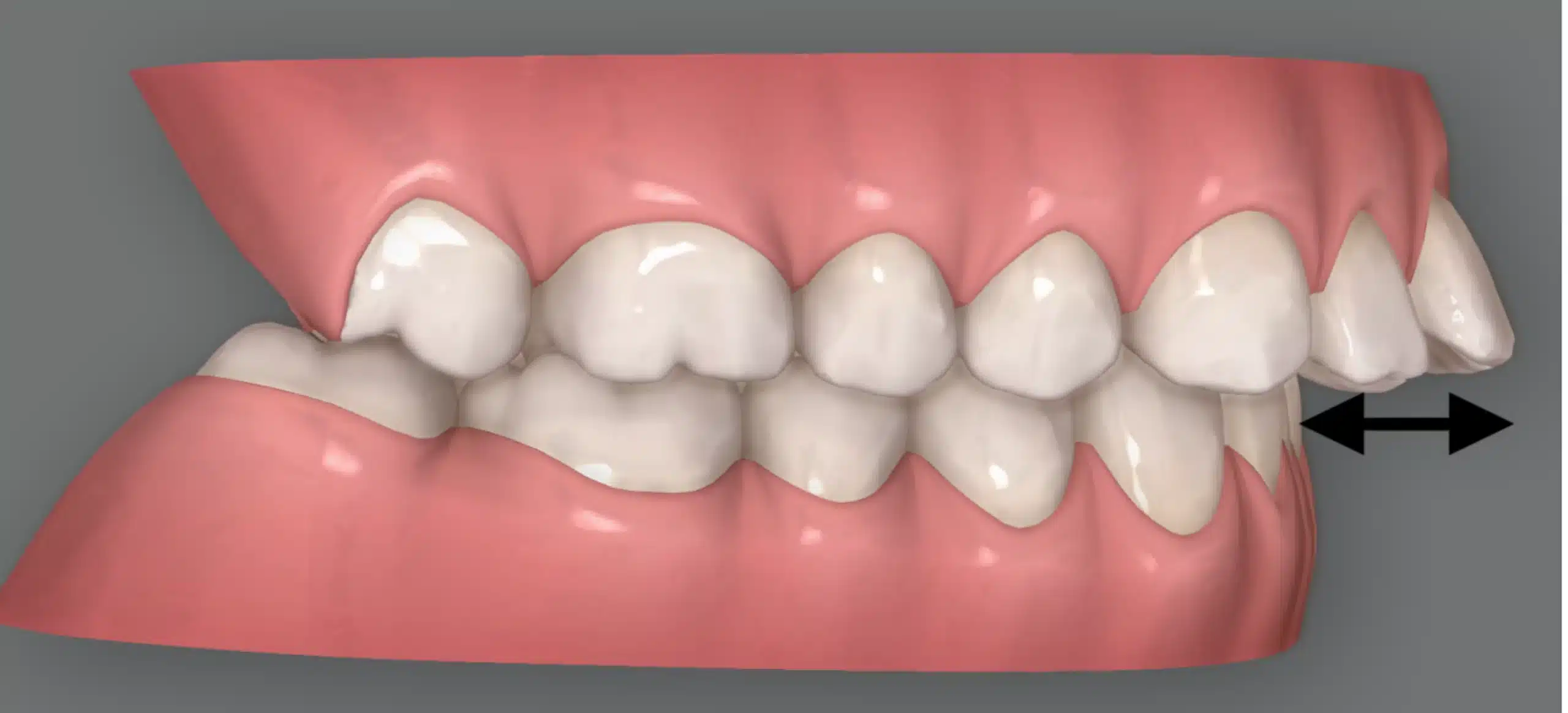 Read more about the article Invisalign for Overjet: How Clear Aligners Correct Front Teeth That Stick Out