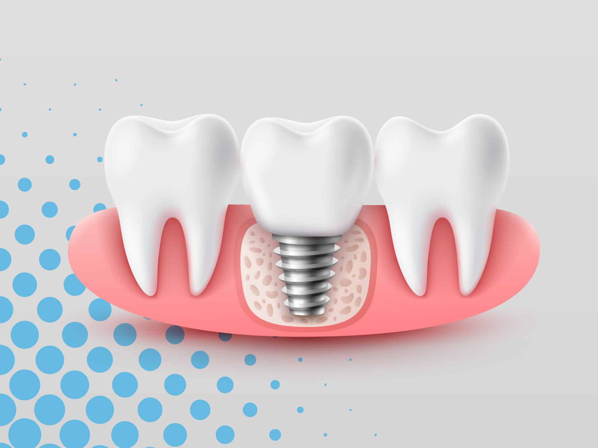 Illustration showing a dental implant placed between two natural teeth