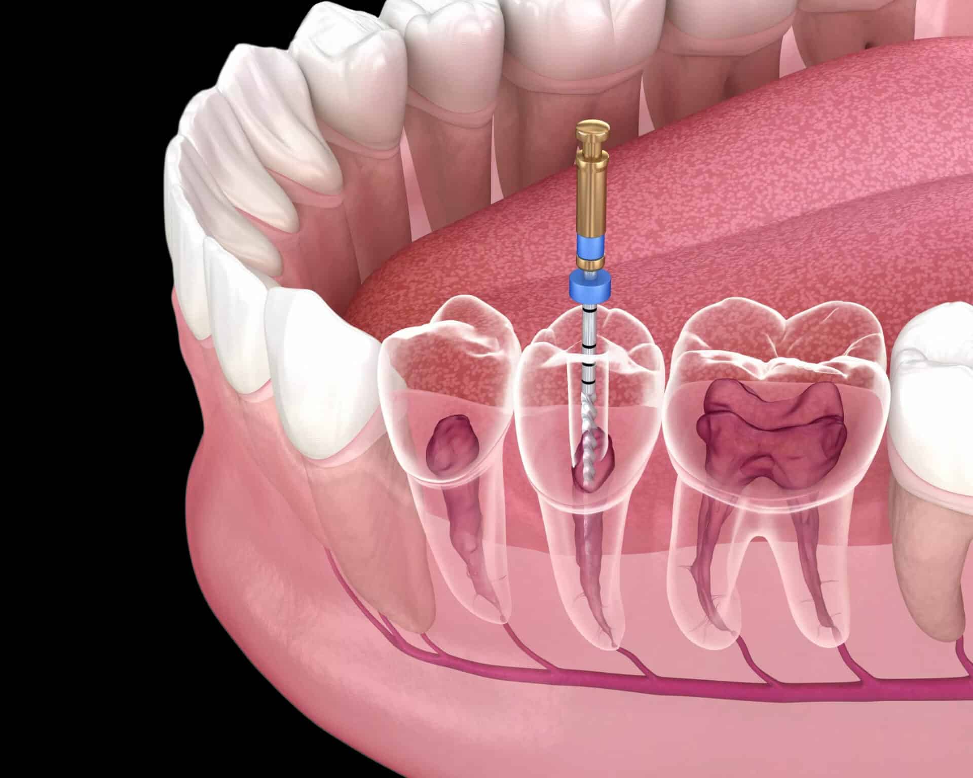 Read more about the article How Long Does a Root Canal Last? Factors That Affect Success Rates