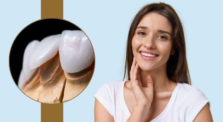 Woman smiling with porcelain dental veneers and close up of veneer tooth structure