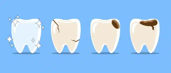 Illustration showing healthy tooth, cracked tooth, and decayed tooth that can cause tooth sensitivity