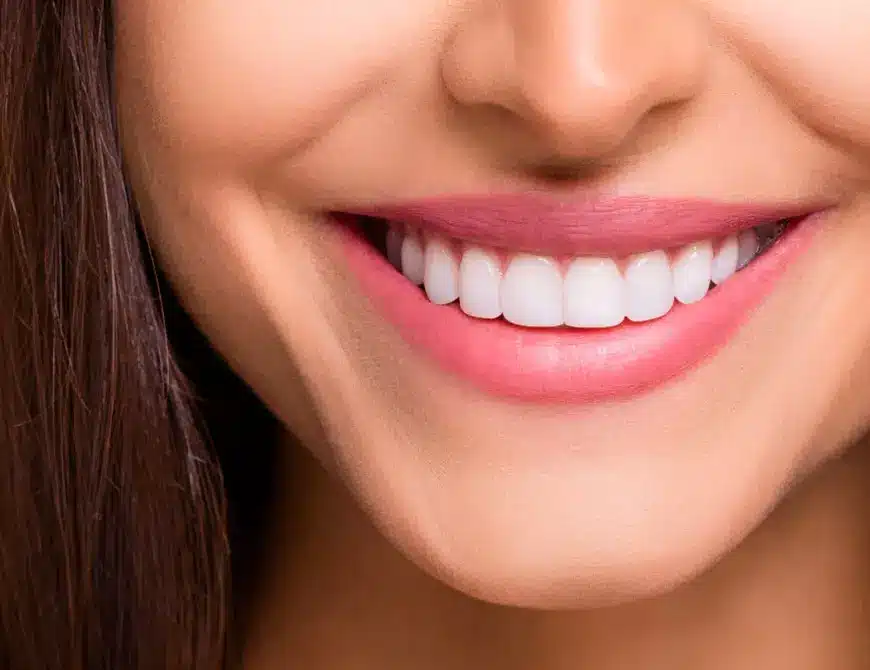 Close-up of a smiling woman showing bright, evenly shaped teeth enhanced with porcelain veneers.