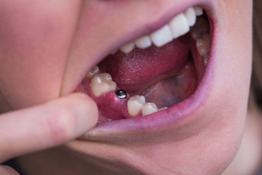 Close-up of a person's lower jaw showing a dental implant abutment between adjacent teeth while a finger pulls the cheek aside.