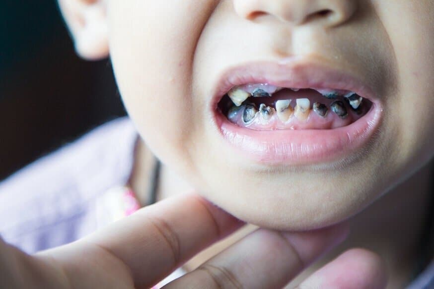 Close-up of a child with multiple decayed primary teeth while an adult supports the chin during an oral examination.