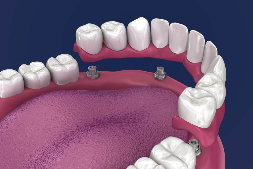 3D illustration of multiple dental implants supporting a fixed bridge to replace several missing teeth in the lower jaw.
