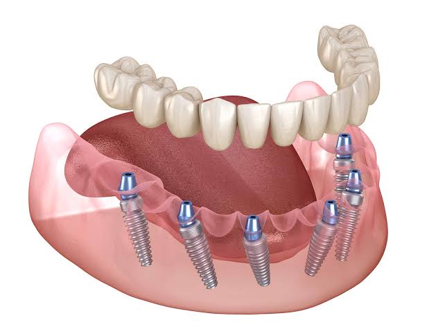 Dental implant-supported lower denture with multiple implants placed along the jaw